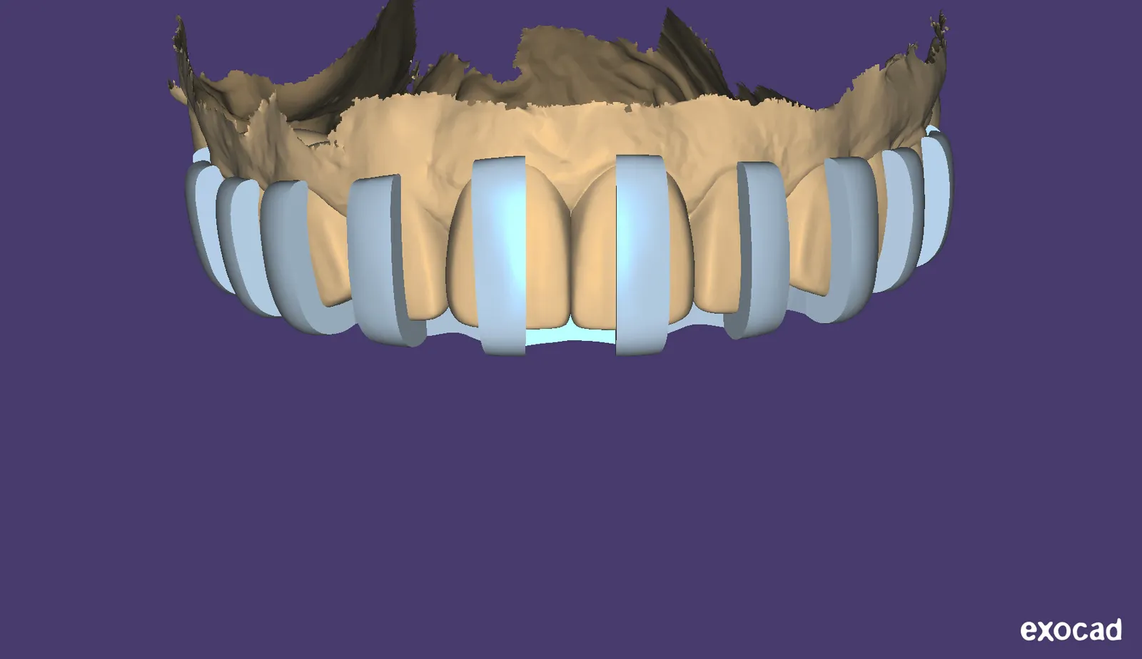Modèle dentaire numérique avec des surfaces de dents modélisées.